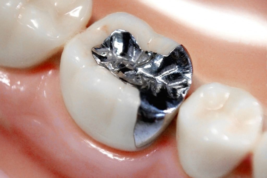 短期間でできるセラミック治療