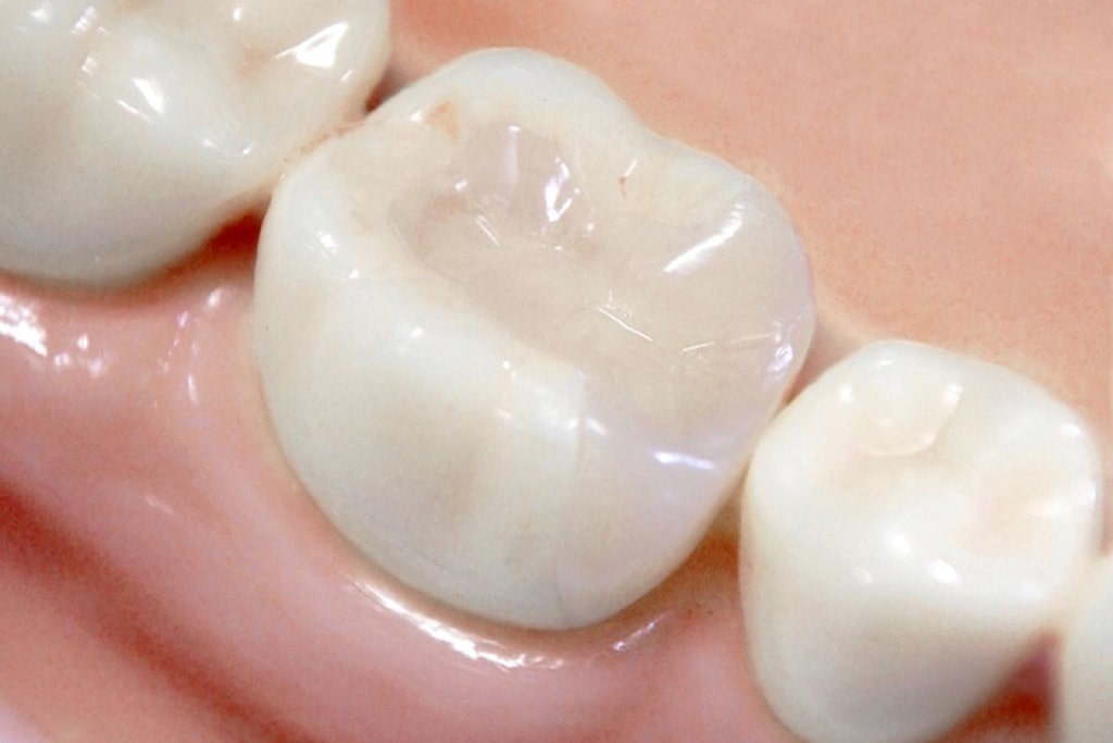 短期間でできるセラミック治療