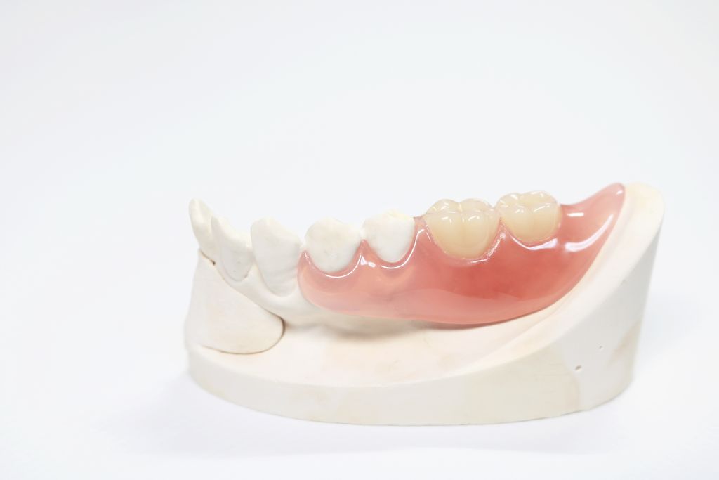 自由診療の入れ歯の種類