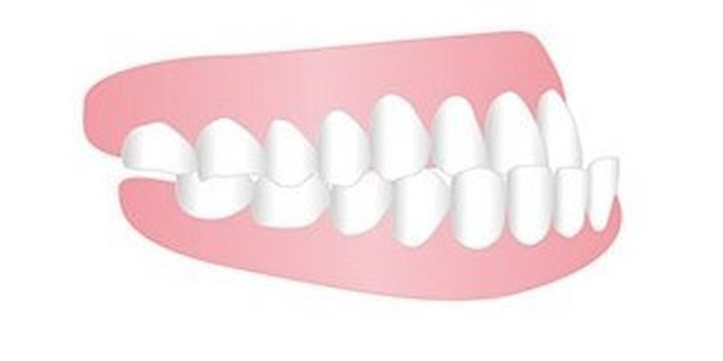 受け口（下顎前突）