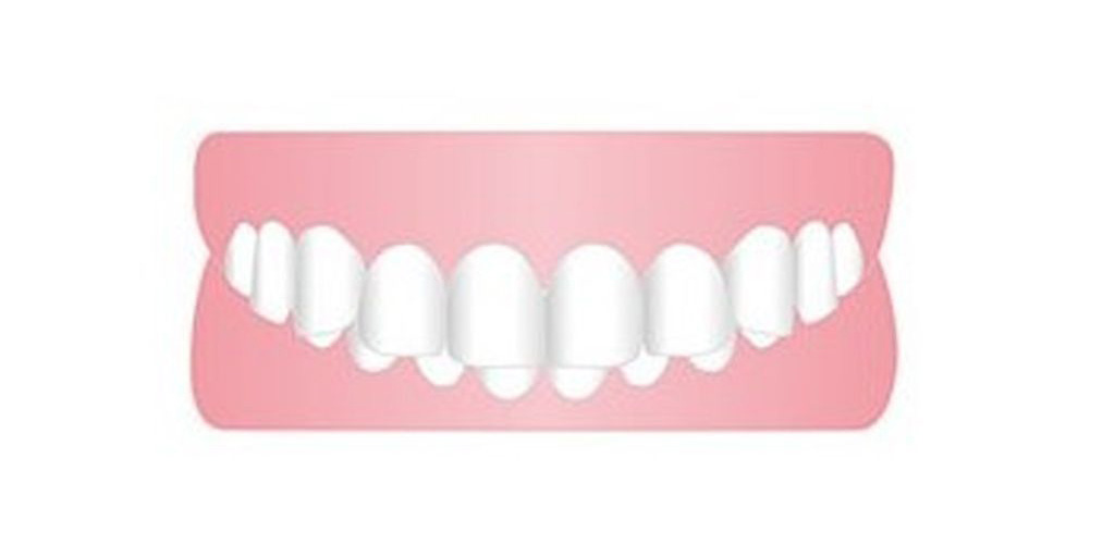 かみ合わせが深い（過剰咬合）