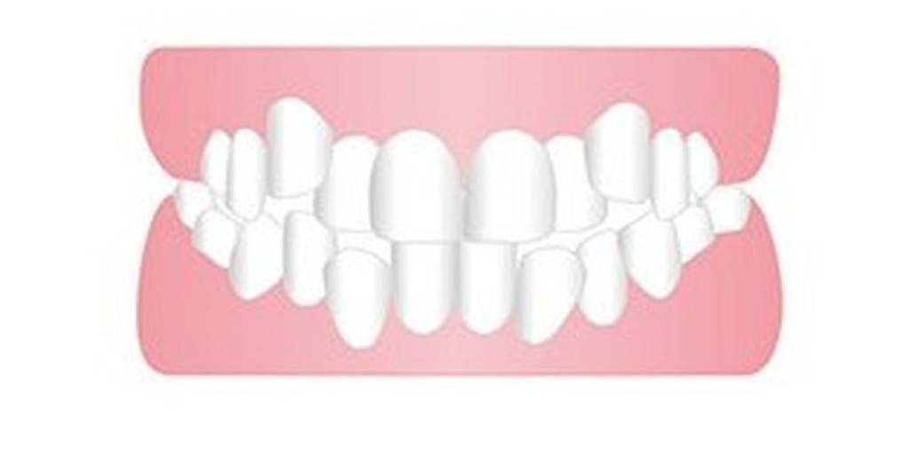 乱ぐい歯（叢生）