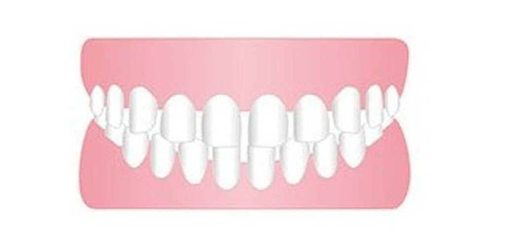 すきっ歯（空隙歯列）