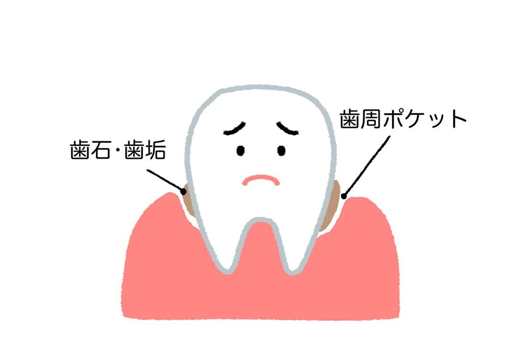 歯周病の最大の原因は？「歯垢(プラーク)」