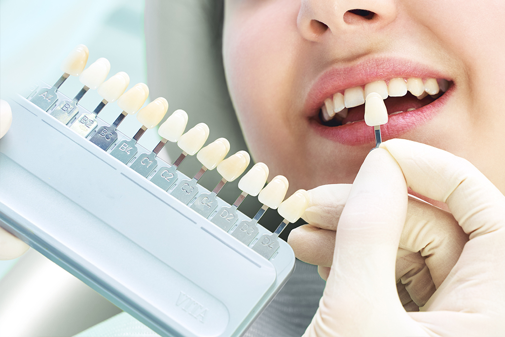 ホワイトニングとは？