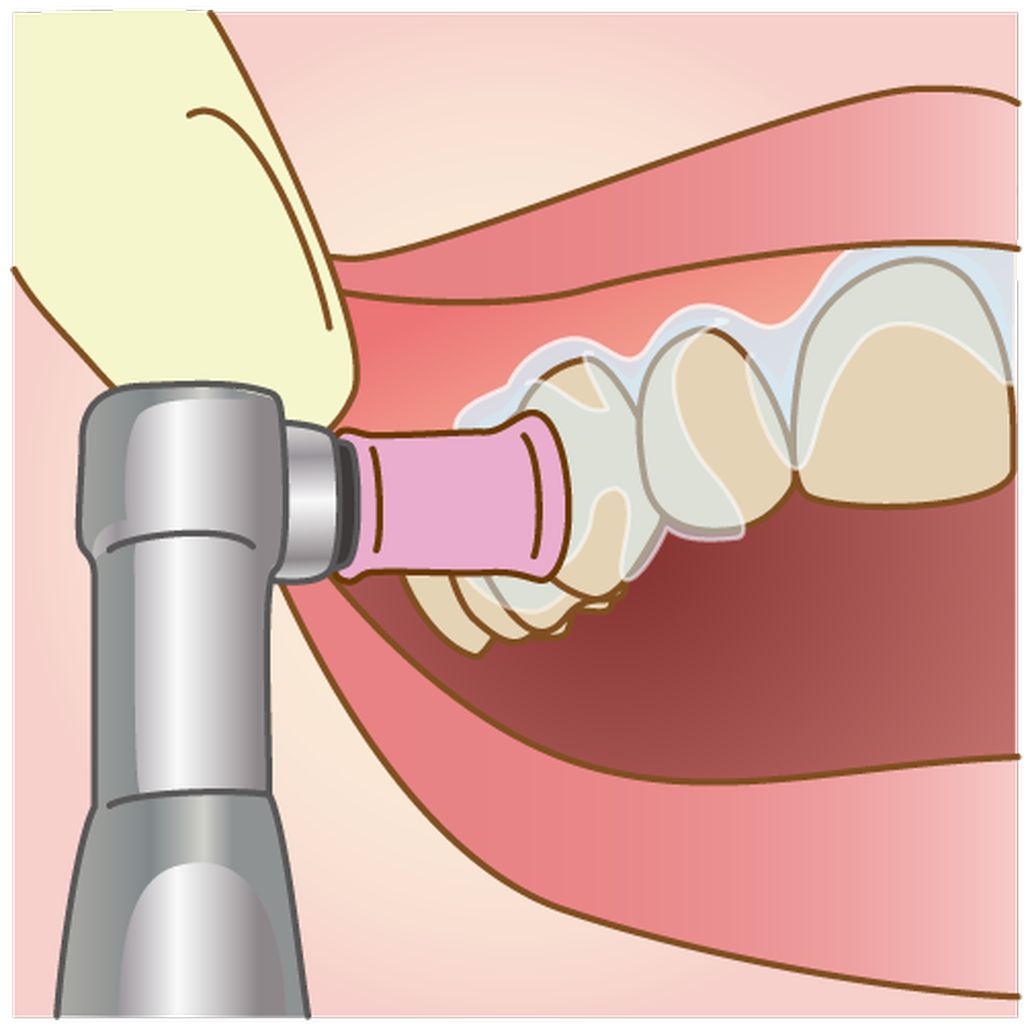 オフィスホワイトニング
